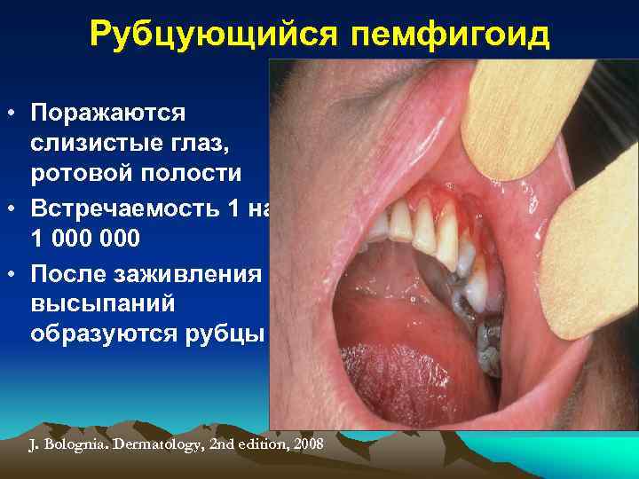 Рубцующийся пемфигоид • Поражаются слизистые глаз, ротовой полости • Встречаемость 1 на 1 000