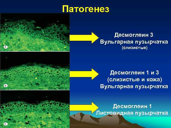 Патогенез Десмоглеин 3 Вульгарная пузырчатка (слизистые) Десмоглеин 1 и 3 (слизистые и кожа) Вульгарная