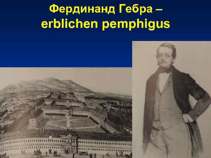 Фердинанд Гебра – erblichen pemphigus 