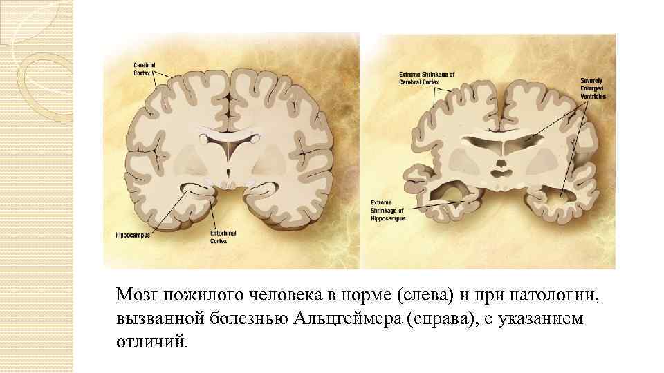 Мозг пожилого человека в норме (слева) и при патологии, вызванной болезнью Альцгеймера (справа), с