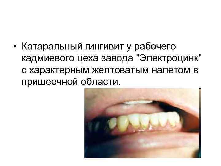 • Катаральный гингивит у рабочего кадмиевого цеха завода "Электроцинк" с характерным желтоватым налетом