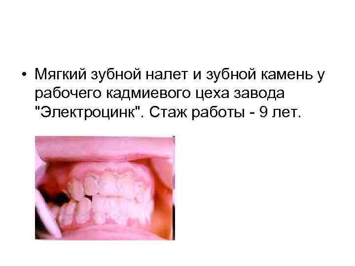  • Мягкий зубной налет и зубной камень у рабочего кадмиевого цеха завода "Электроцинк".