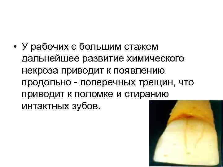  • У рабочих с большим стажем дальнейшее развитие химического некроза приводит к появлению