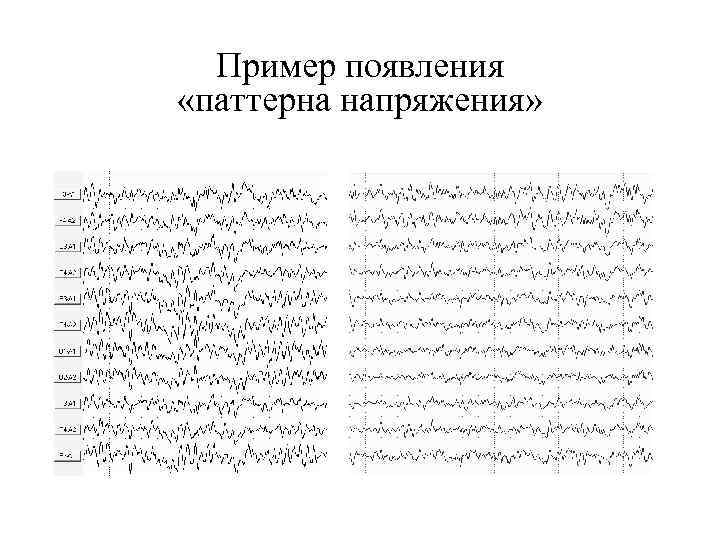 Пример появления «паттерна напряжения» 