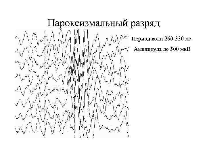 Пароксизмальный разряд Период волн 260 -330 мс. Амплитуда до 500 мк. В 