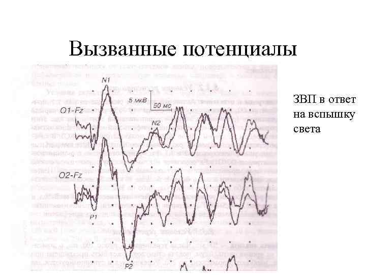 Зрительные вызванные потенциалы