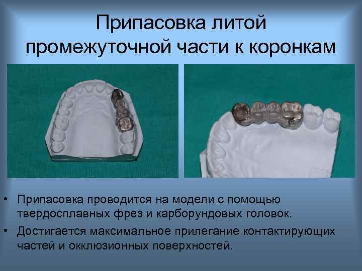 Припасовка литой промежуточной части к коронкам • Припасовка проводится на модели с помощью твердосплавных