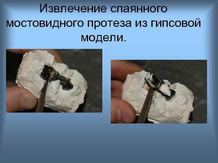 Извлечение спаянного мостовидного протеза из гипсовой модели. 