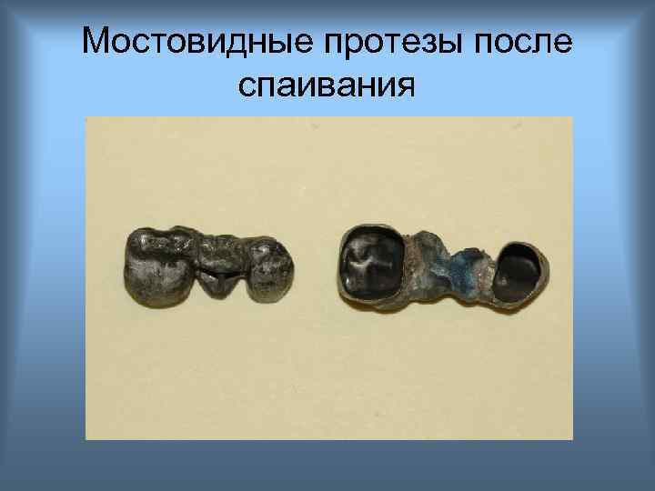 Мостовидные протезы после спаивания 