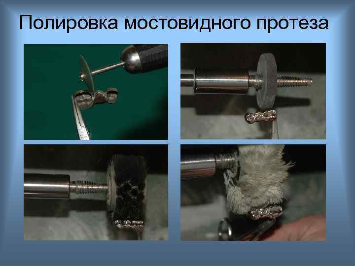 Полировка мостовидного протеза 
