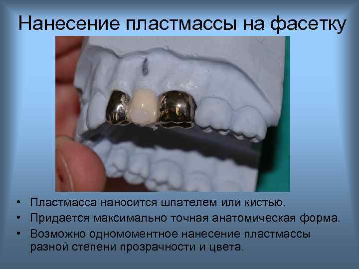 Нанесение пластмассы на фасетку • Пластмасса наносится шпателем или кистью. • Придается максимально точная