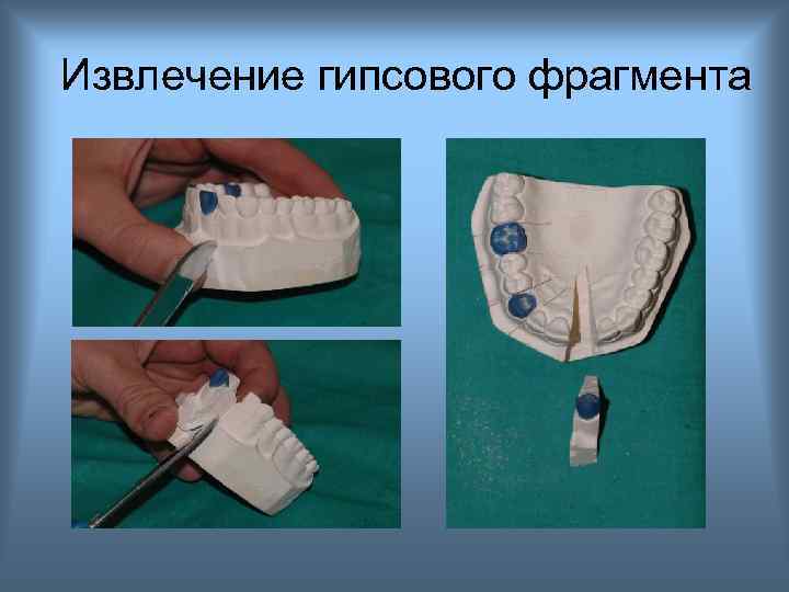 Извлечение гипсового фрагмента 