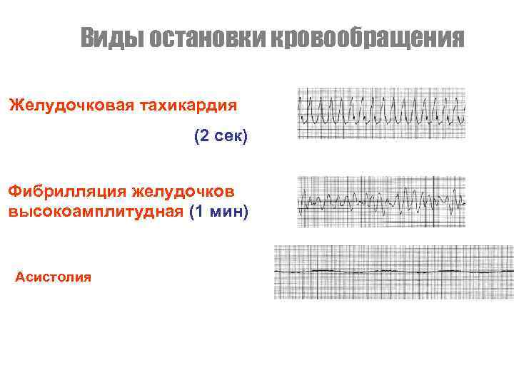 Виды остановки кровообращения Желудочковая тахикардия (2 сек) Фибрилляция желудочков высокоамплитудная (1 мин) Асистолия 