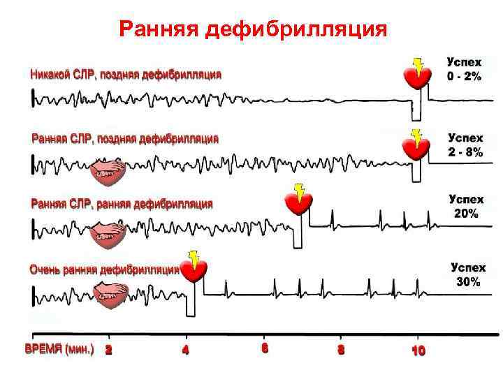 Ранняя дефибрилляция Lev Subbotin© ПЕРМСКАЯ Школа Медицины Катастроф 