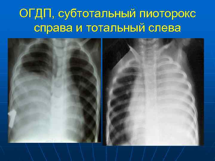 ОГДП, субтотальный пиоторокс справа и тотальный слева 