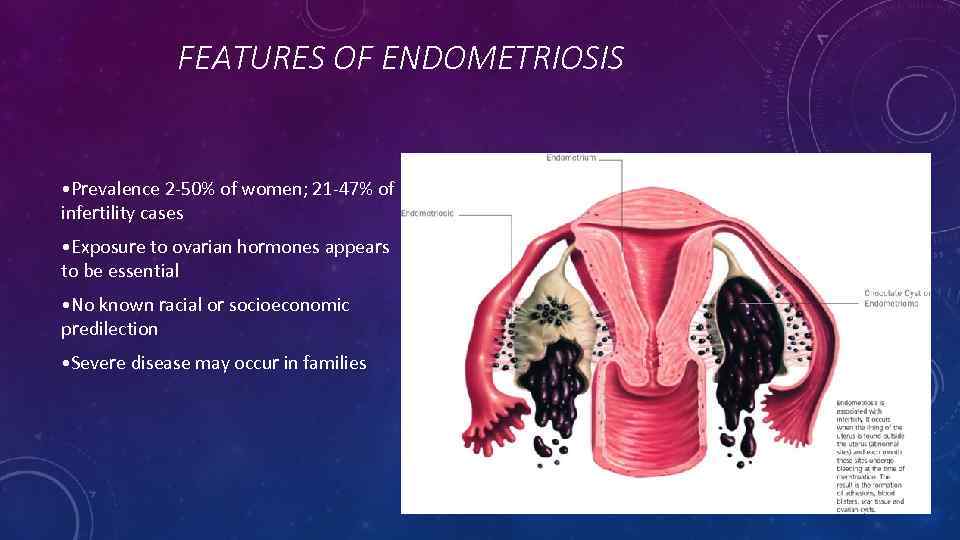 FEATURES OF ENDOMETRIOSIS • Prevalence 2 -50% of women; 21 -47% of infertility cases