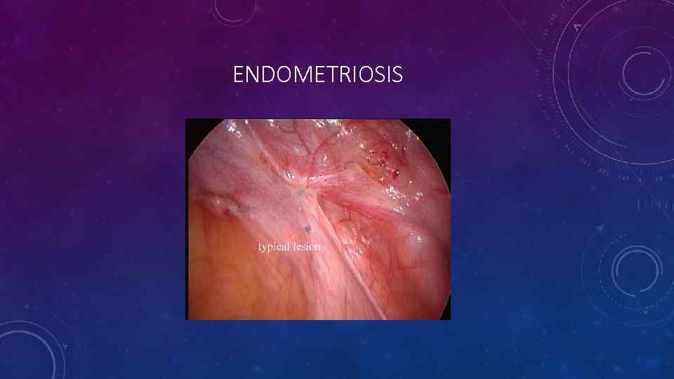 ENDOMETRIOSIS 