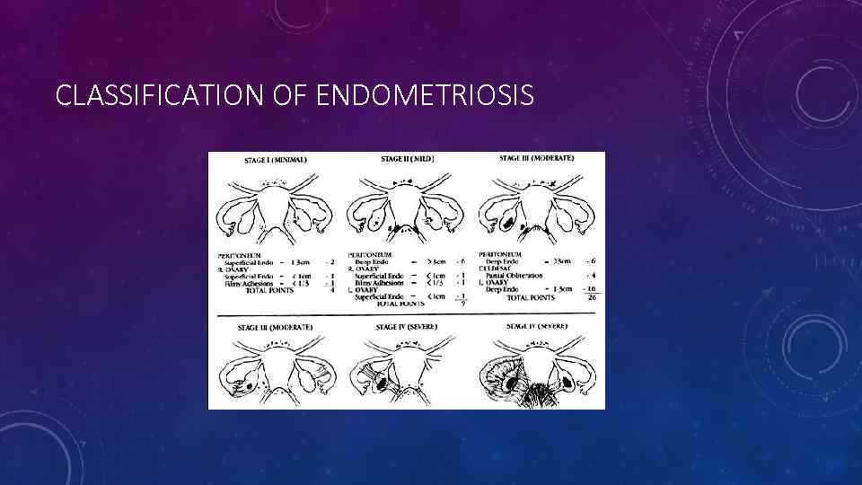 CLASSIFICATION OF ENDOMETRIOSIS 