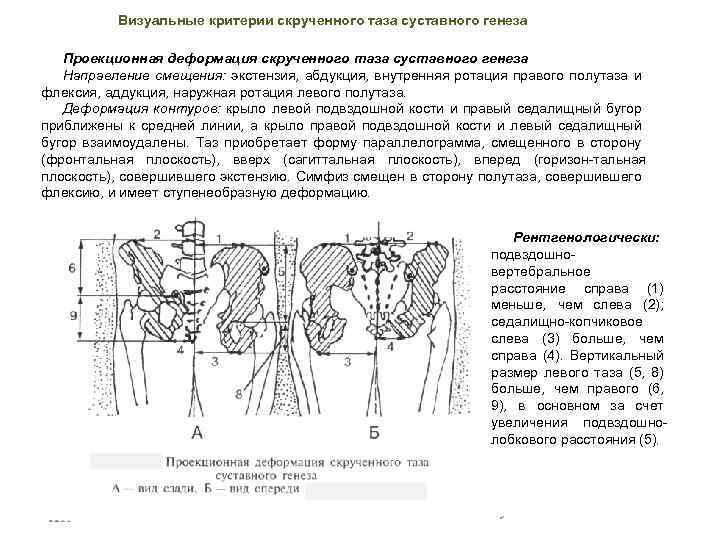 Визуальные критерии скрученного таза суставного генеза Проекционная деформация скрученного таза суставного генеза Направление смещения: