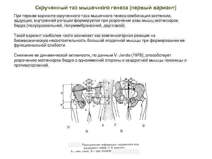 Скрученный таз мышечного генеза (первый вариант) При первом варианте скрученного таза мышечного генеза комбинация