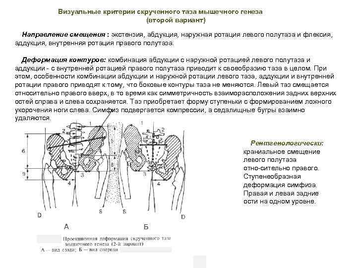 Визуальные критерии скрученного таза мышечного генеза (второй вариант) Направление смещения : экстензия, абдукция, наружная