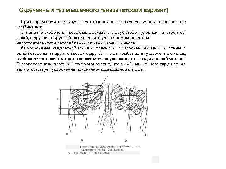 Косо скрученный таз фото