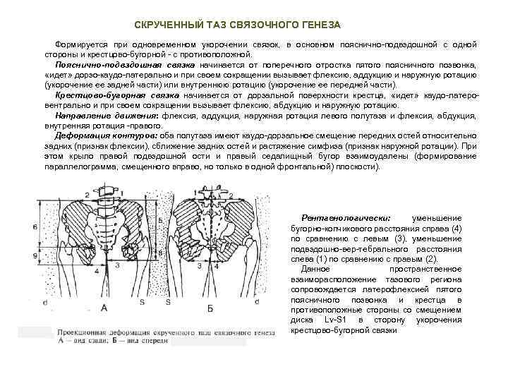 СКРУЧЕННЫЙ ТАЗ СВЯЗОЧНОГО ГЕНЕЗА Формируется при одновременном укорочении связок, в основном пояснично подвздошной с