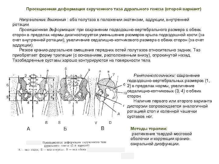 Проекционная деформация скрученного таза дурального генеза (второй вариант) Направление движения : оба полутаза в