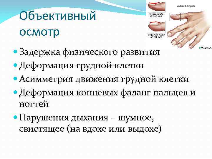 Объективный осмотр Задержка физического развития Деформация грудной клетки Асимметрия движения грудной клетки Деформация концевых