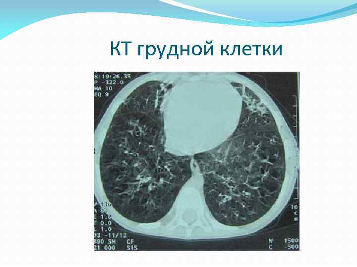 КТ грудной клетки 