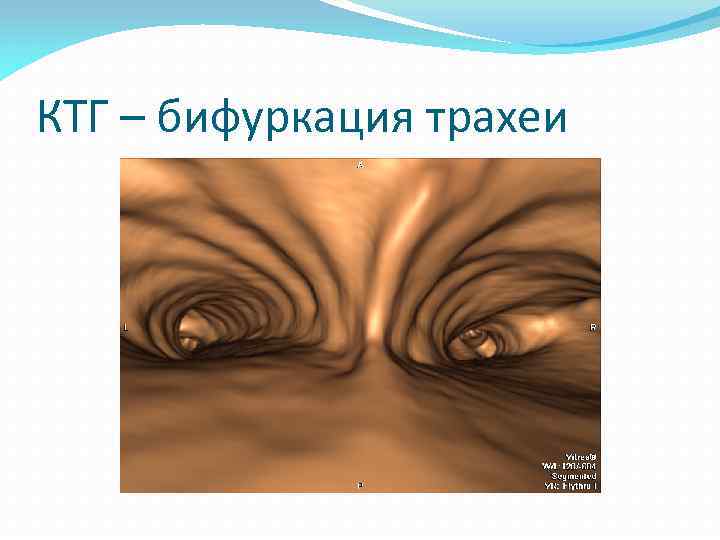 КТГ – бифуркация трахеи 