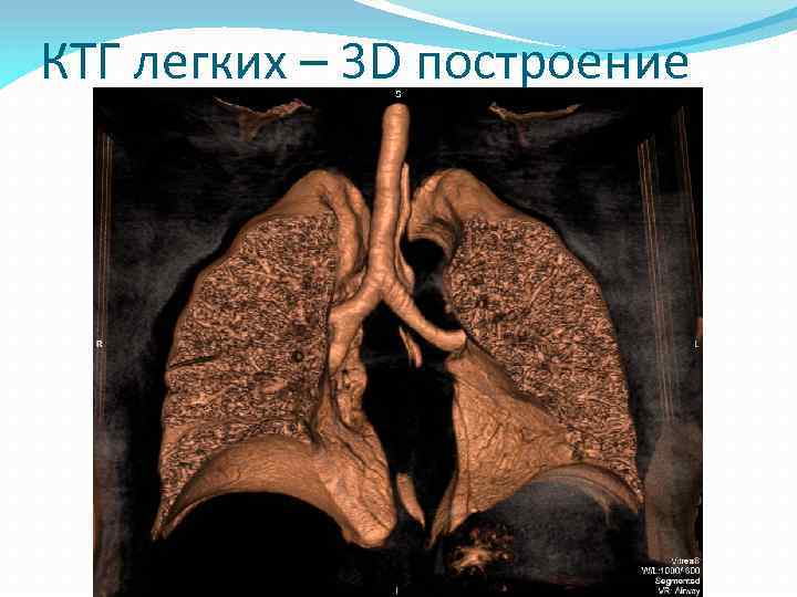 КТГ легких – 3 D построение 