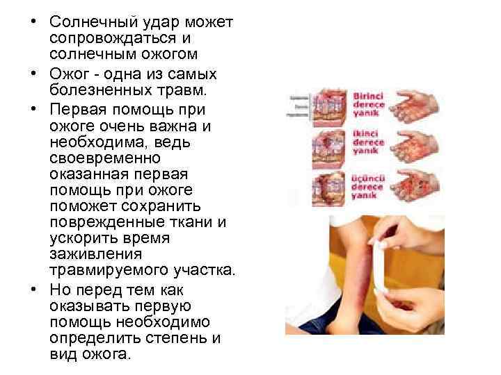  • Солнечный удар может сопровождаться и солнечным ожогом • Ожог - одна из
