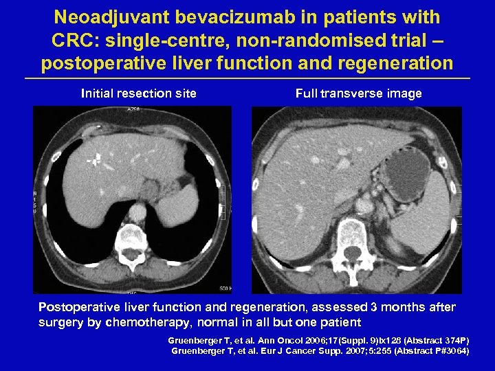 Neoadjuvant bevacizumab in patients with CRC: single-centre, non-randomised trial – postoperative liver function and