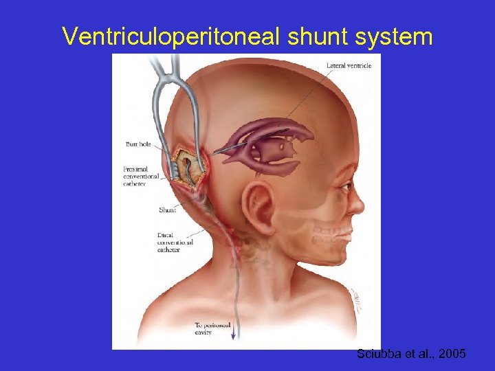 Ventriculoperitoneal shunt system Sciubba et al. , 2005 