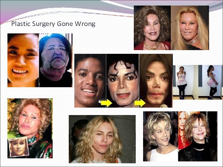 Plastic Surgery Gone Wrong 