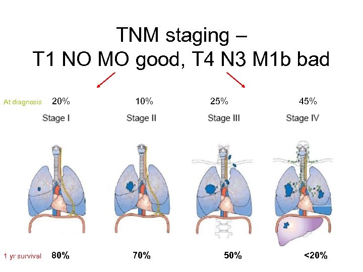 TNM staging – T 1 NO MO good, T 4 N 3 M 1