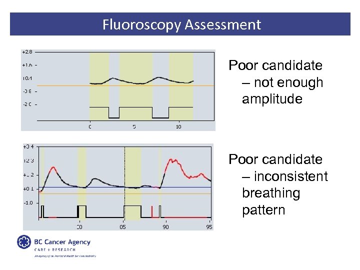 Fluoroscopy Assessment Poor candidate – not enough amplitude Poor candidate – inconsistent breathing pattern