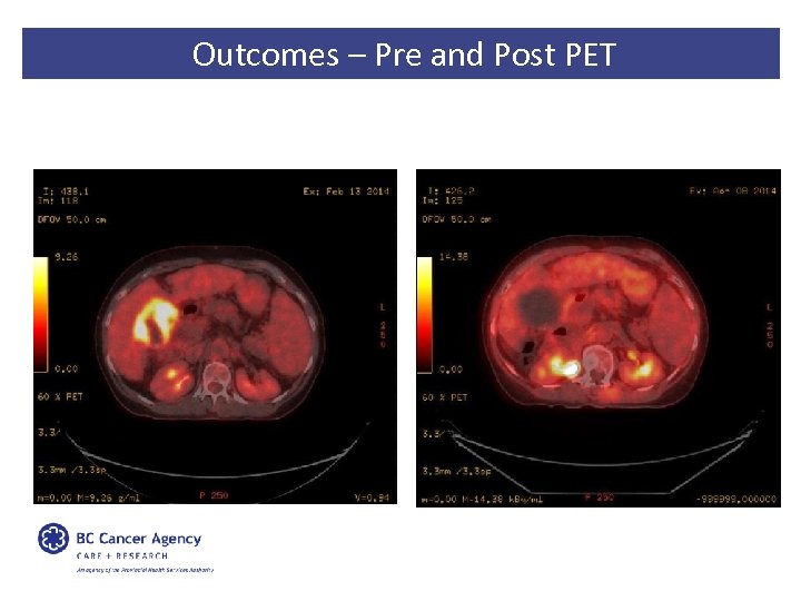 Outcomes – Pre and Post PET 