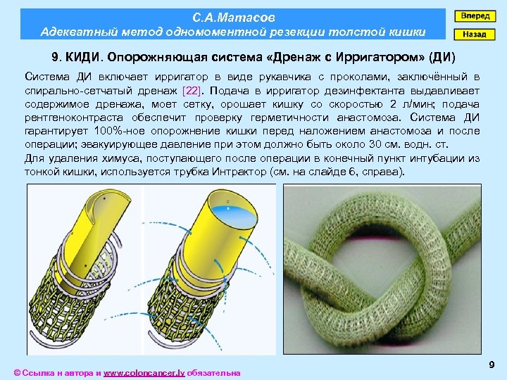 С. А. Матасов Адекватный метод одномоментной резекции толстой кишки 9. КИДИ. Опорожняющая система «Дренаж