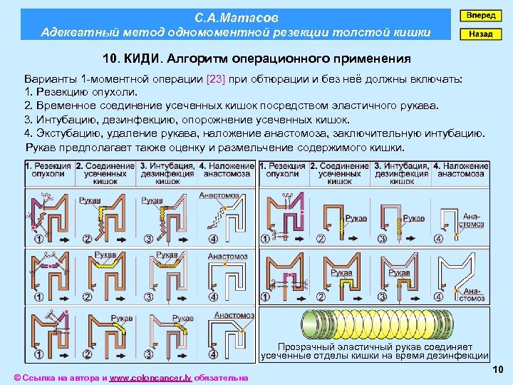 С. А. Матасов Адекватный метод одномоментной резекции толстой кишки 10. КИДИ. Алгоритм операционного применения