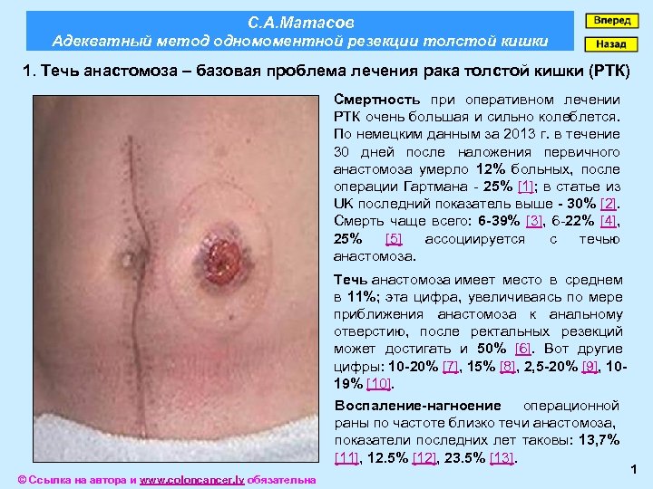 С. А. Матасов Адекватный метод одномоментной резекции толстой кишки 1. Течь анастомоза – базовая