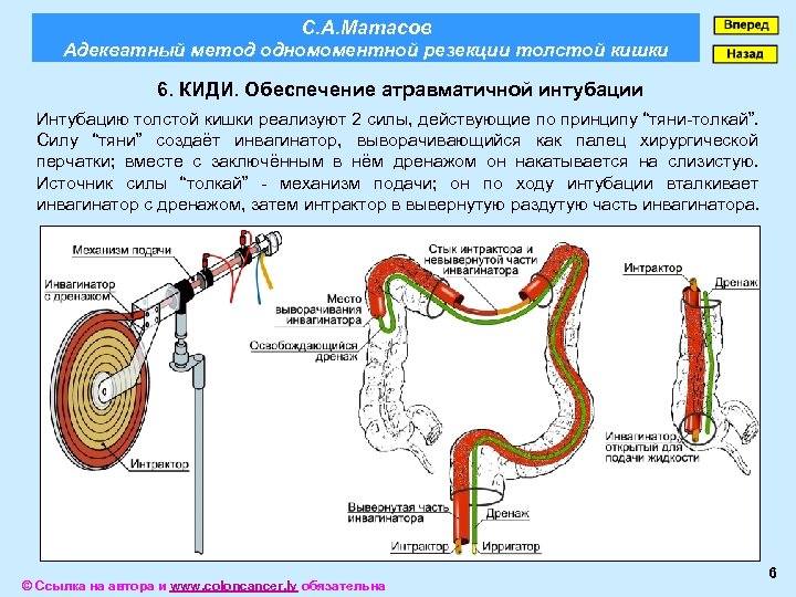 С. А. Матасов Адекватный метод одномоментной резекции толстой кишки 6. КИДИ. Обеспечение атравматичной интубации