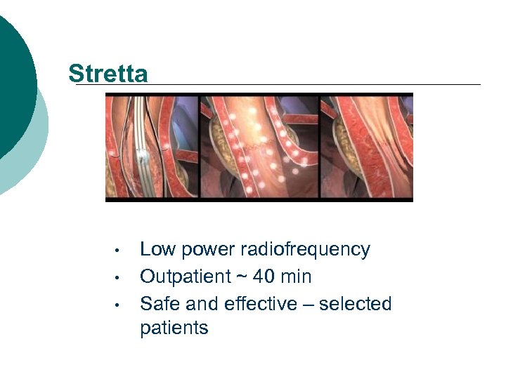 Stretta • • • Low power radiofrequency Outpatient ~ 40 min Safe and effective