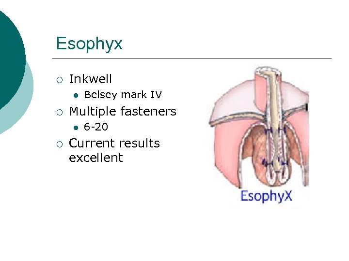 Esophyx ¡ Inkwell ¡ Multiple fasteners ¡ Belsey mark IV 6 -20 Current results