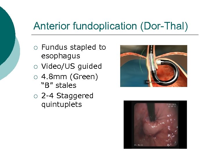 Anterior fundoplication (Dor-Thal) ¡ ¡ Fundus stapled to esophagus Video/US guided 4. 8 mm