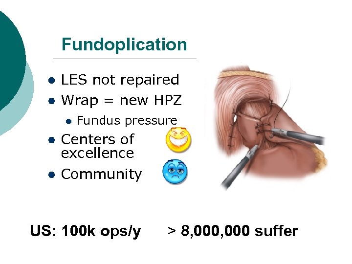 Fundoplication LES not repaired Wrap = new HPZ Fundus pressure Centers of excellence Community