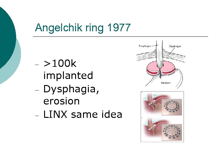 Angelchik ring 1977 >100 k implanted Dysphagia, erosion LINX same idea 