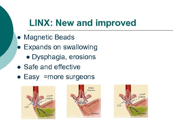 LINX: New and improved Magnetic Beads Expands on swallowing Dysphagia, erosions Safe and effective