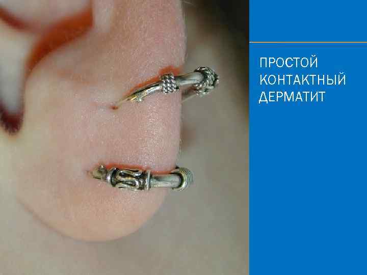 ПРОСТОЙ КОНТАКТНЫЙ ДЕРМАТИТ 
